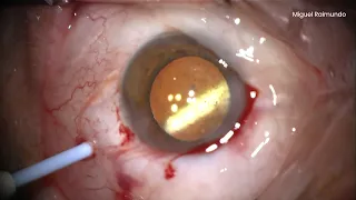 Cataract surgery in panuveitis, mechanical fracturing/chopping, intravitreal dexamethasone implant