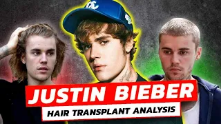 How Justin Bieber SECRETLY Reversed His Hair Loss