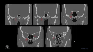 Skull Base Imaging ASHNR20