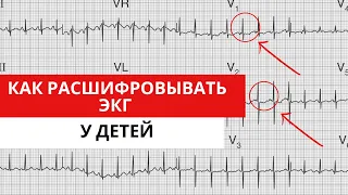 ЭКГ У ДЕТЕЙ. Особенности анализа ЭКГ. Отличие от взрослой ЭКГ.