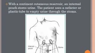 Urinary Diversions Presentation