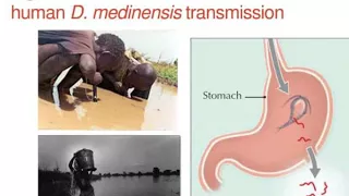 dracunculiasis guinea worm disease