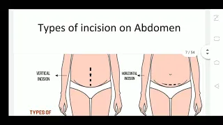 Caesarian Section 1