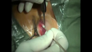 Mullerectomy for upper lid retraction by Dr Hunter Yuen