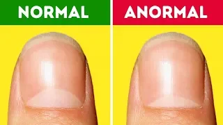 13 Problemas de Saúde Que Podem Ser Avisados pelas Suas Unhas