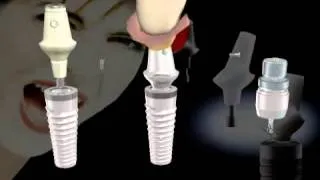 Ankylos Implant System