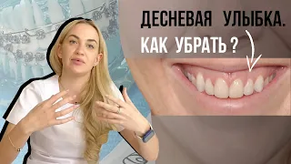 Десневая улыбка. Как исправить? Поможет ортодонт, хирург или косметолог?