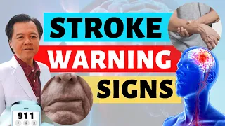 Stroke Warning Signs: A Simple Guide - By Doctor Willie Ong (Cardiologist & Internist)