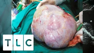 The World's Biggest Cyst | Body Bizarre