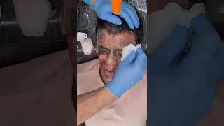 Leandro Part. 2 | Remoção de Tatuagem