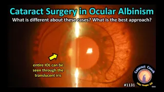 CataractCoach 1131: cataract surgery in ocular albinism