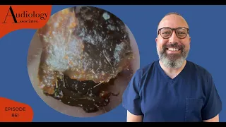 DARK EAR WAX PLUG REMOVAL FROM EAR - EP861