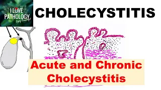 CHOLECYSTITIS: Acute and Chronic. Pathology and Complications