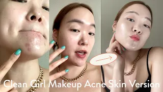 Clean Girl Makeup for Acne-Prone Skin!