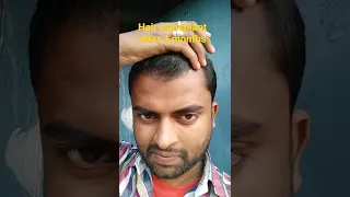 hair transplant after 4 months result in india ||2022||