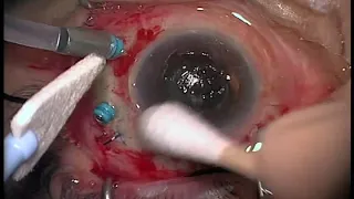 Neovascular Glaucoma Pars Plana Molteno III Tube Placement With Vitrectomy and 20% SF6 Gas Bubble