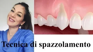 Tecnica di spazzolamento in presenza di retrazioni gengivali