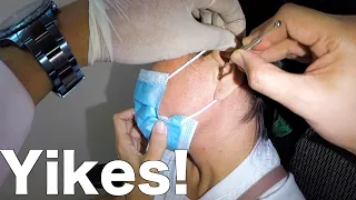 Removing Woman's Big Black Earwax Stuck In Her Ear