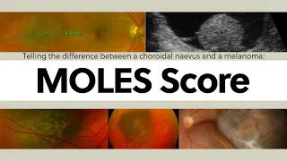 Telling the difference between a choroidal naevus and a melanoma: The MOLES Score | OT Skills Guide