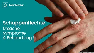 Behandlungsmöglichkeiten bei Schuppenflechte - Tipps und Therapien für eine gesunde Haut