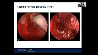 A Fungus Among Us: Fungal Sinusitis and the COVID19 impact.