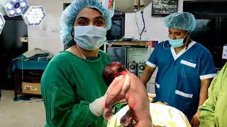 Caesarean Section Surgery(LUCS) steps - C - section - Cesarean delivery in live (Full)