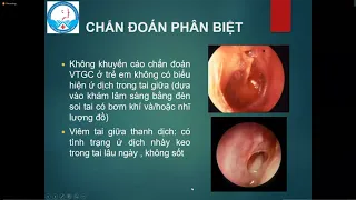 Chẩn đoán và xử lý viêm tai giữa trẻ em 02/10/2021