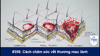 # 359. Chăm sóc vết thương: Không dùng oxy già (hydrogen peroxide)