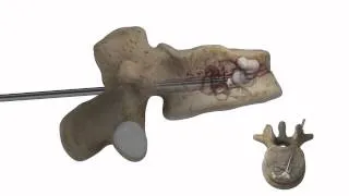 Augmenta Vertebral Augmentation Device