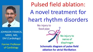 Pulsed field ablation – A novel treatment for heart rhythm disorders