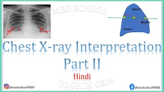 Chest X-ray interpretation made easy- Anatomical structures Hindi