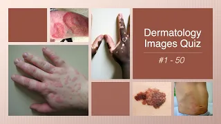 Dermatology Images Quiz #1 - 50