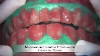 Sbiancamento Professionale dei Denti (Teeth Whitening)