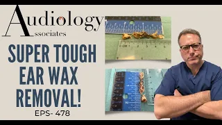 SUPER TOUGH EAR WAX REMOVAL - EP478