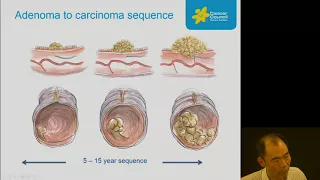 Find Cancer Early Webinar Series – Colorectal Cancer