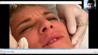 Webinar Lips volume and periorbital enhancement talk ( part 4)