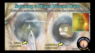 CataractCoach 1302: how to suture a phaco wound burn