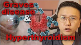 GRAVES Disease and Hyperthyroidism explained - Symptoms & treatment