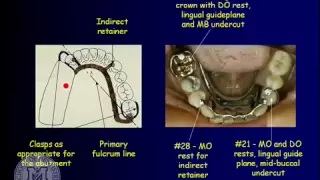 DENT 718: Removable partial dentures: design considerations