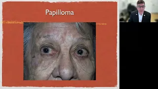 Lecture: Masses and Bumps of the Eyelids: Practical Approaches to Diagnosis and Management