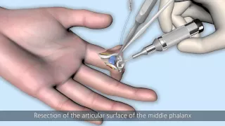 CapFlex PIP – Endoprosthetic treatment of the proximal interphalangeal joint (palmar approach)