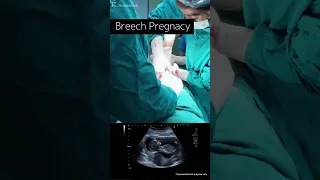 Caesarean Section for Breech Baby | Breech Pregnancy