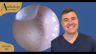 EAR WAX REMOVAL FROM A VERY NARROW EAR CANAL - EP763