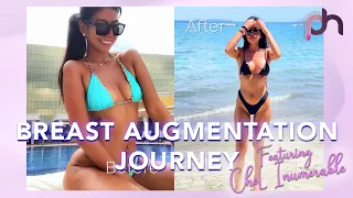 Breast Augmentation Journey featuring Chel Inumerable