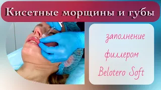 Заполнение кисетных морщин филлером Belotero Soft и увеличение губ