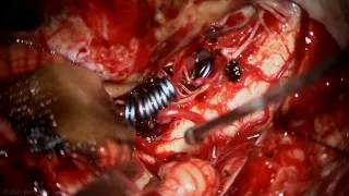 Far Lateral Approach for Clip Reconstruction of a Ruptured Dolichoectatic PICA Aneurysm