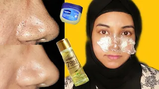 Instantly MELT BLACKHEADS w/ VASELINE + OIL! How to remove Blackheads | Irin Yousuf