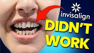 The BRUTAL TRUTH about Invisalign...watch BEFORE you buy