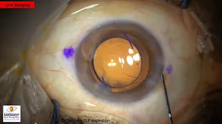 Live Surgery White cataract Dr Sourabh D Patwardhan Cataract