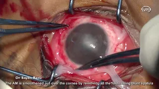 Surgical Technique of Simple Limbal Epithelial Transplantation (SLET)